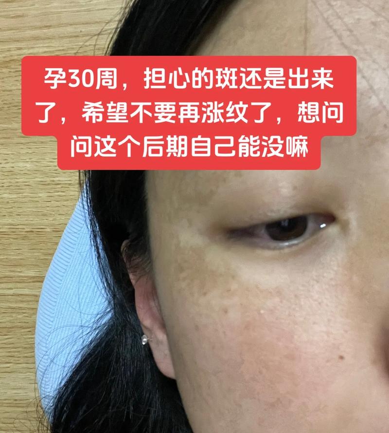 怀孕期间长斑是激素变化导致？还是身体发出的健康预警？-第3张图片-郑州医学网