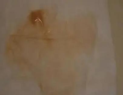 怀孕期间出现棕色分泌物，是正常现象还是身体异常信号？-第2张图片-郑州医学网