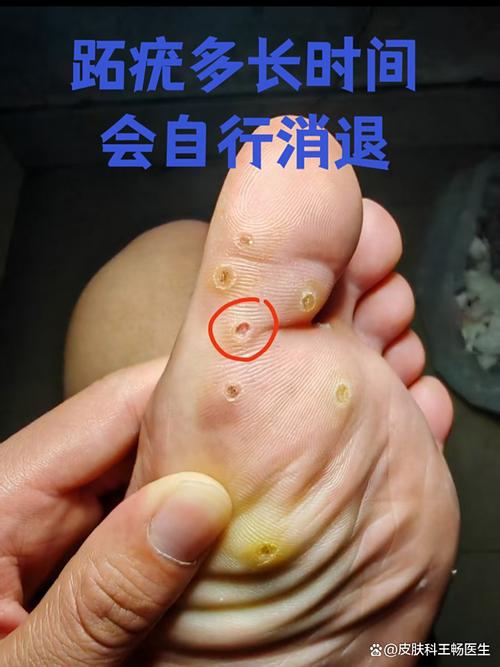 儿童脚上长跖疣，不治会自己好吗？该怎么处理才好？-第2张图片-郑州医学网