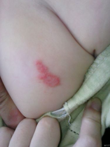 新生儿大腿肌肉摸到硬块是正常现象还是疾病信号?-第2张图片-郑州医学网 新生儿大腿肌肉摸到硬块是正常现象还是疾病信号?-第2张图片-郑州医学网