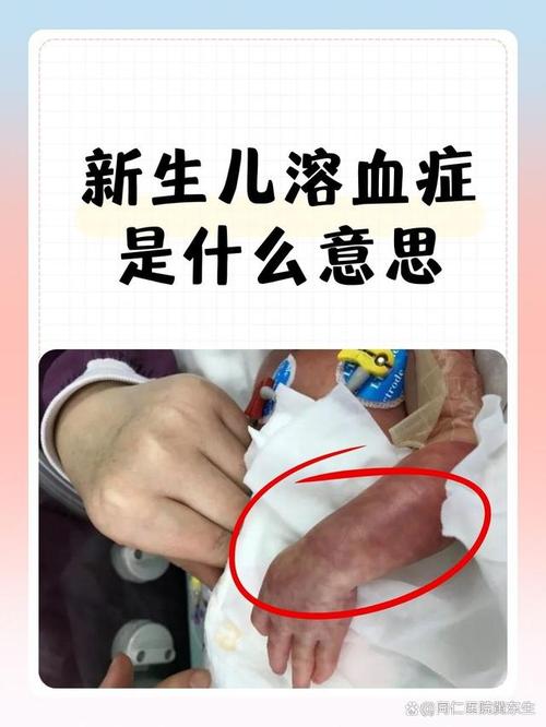 新生儿溶血症黄疸换血治疗的风险与效果如何评估？-第2张图片-郑州医学网