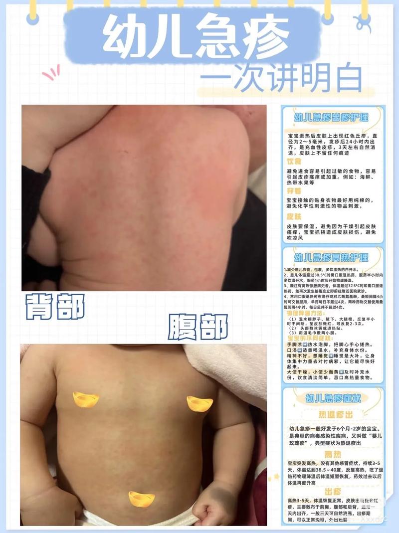 新生儿湿疹发烧是病情加重了吗？需要怎么处理？-第1张图片-郑州医学网