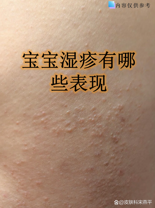 新生儿湿疹发烧是病情加重了吗？需要怎么处理？-第2张图片-郑州医学网