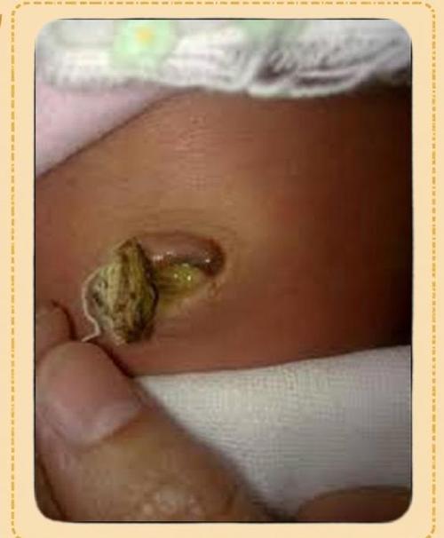 新生儿脐带掉落后流脓是感染了吗？该怎么处理才正确？-第3张图片-郑州医学网