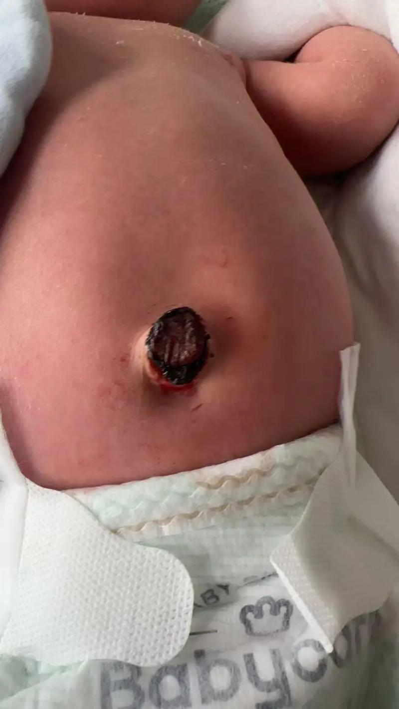 新生儿脐带掉落后流脓是感染了吗？该怎么处理才正确？-第2张图片-郑州医学网
