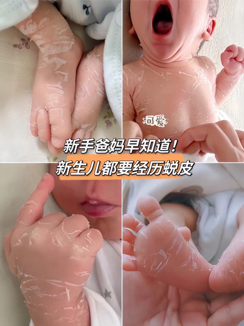 新生儿脚上脱皮是正常生理现象还是需要警惕的健康问题？-第3张图片-郑州医学网