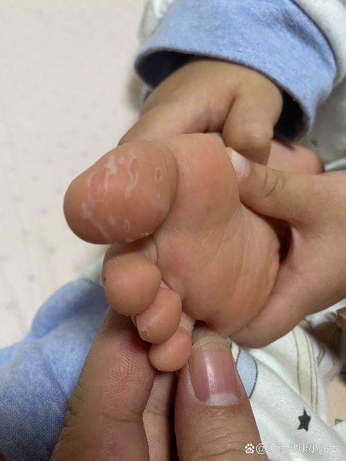 新生儿脚上脱皮是正常生理现象还是需要警惕的健康问题？-第1张图片-郑州医学网