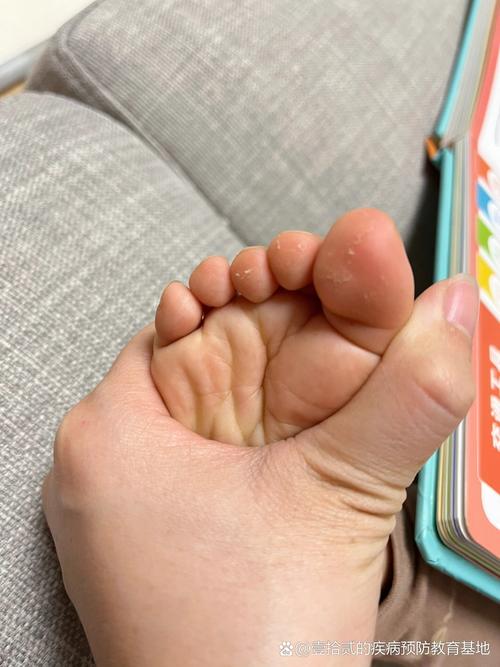 新生儿脚上脱皮是正常生理现象还是需要警惕的健康问题？-第2张图片-郑州医学网