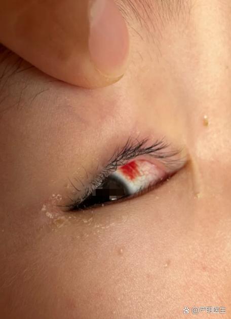 新生儿眼睛被强光刺激后，会留下永久性损伤吗？-第3张图片-郑州医学网