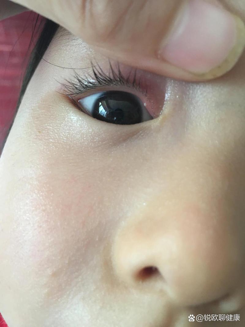 新生儿睫毛根部长痘痘是正常现象吗？需要处理吗？-第1张图片-郑州医学网