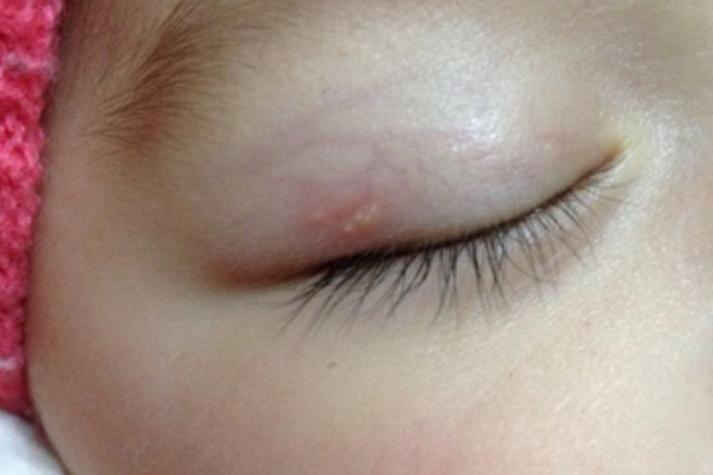 新生儿睫毛根部长痘痘是正常现象吗？需要处理吗？-第2张图片-郑州医学网