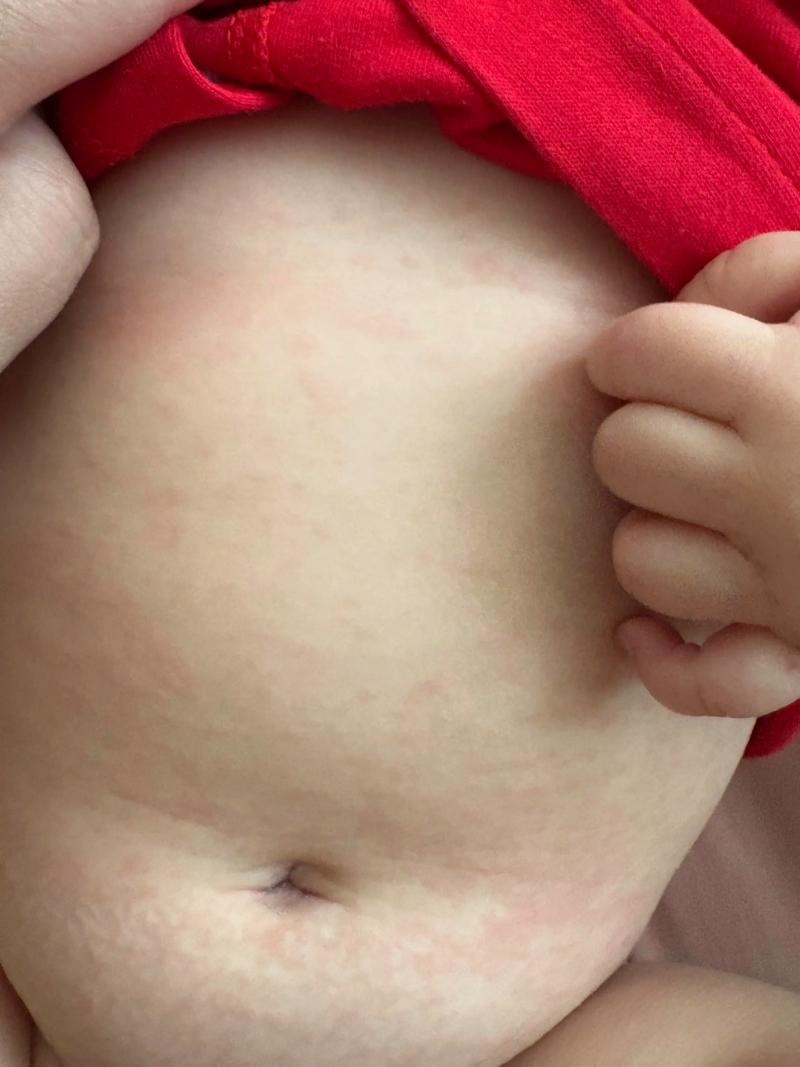 新生儿肚脐周围红疹是感染还是过敏？该怎么护理才好？-第2张图片-郑州医学网