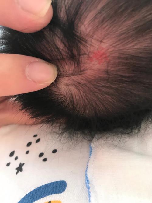 新生儿宝宝头部有血肿-第2张图片-郑州医学网