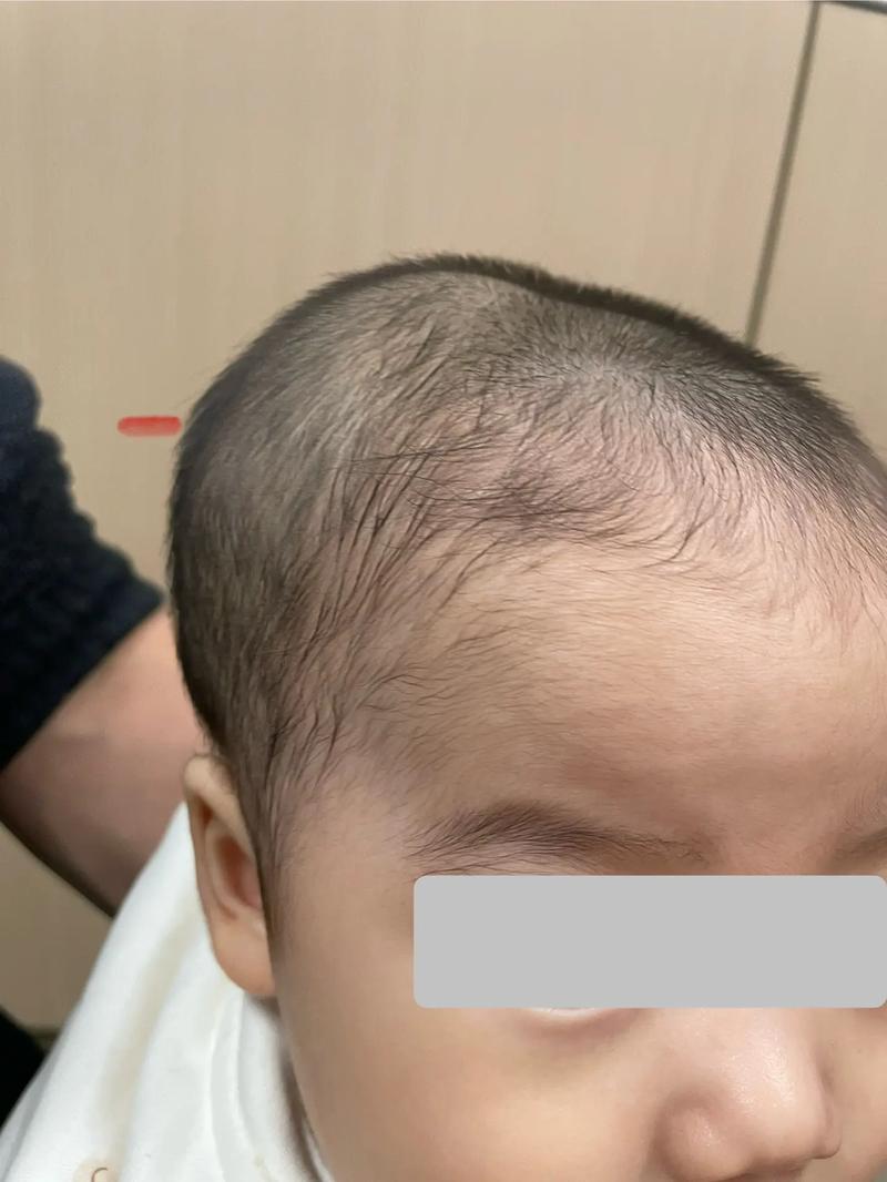 新生儿宝宝头部有血肿-第1张图片-郑州医学网