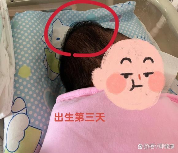 新生儿宝宝头部有血肿-第3张图片-郑州医学网