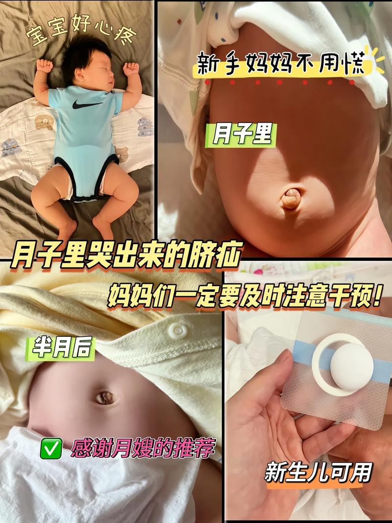 新生儿脐疝一般多久能自行愈合？家长日常护理要注意哪些事项？-第1张图片-郑州医学网