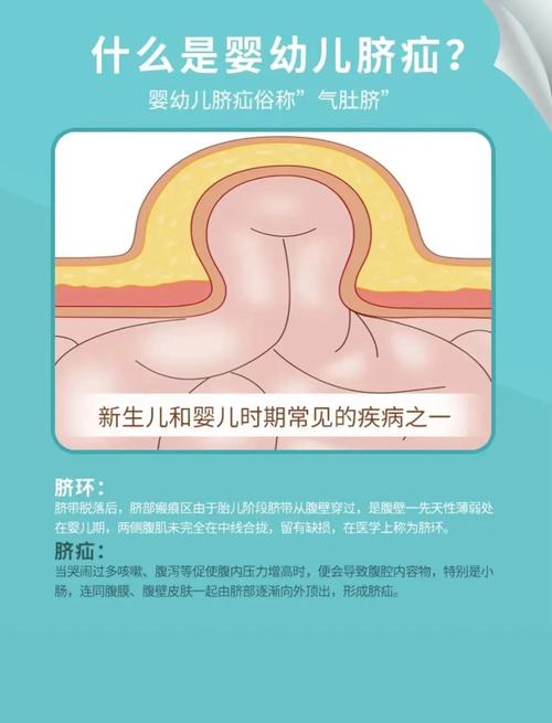 新生儿脐疝一般多久能自行愈合？家长日常护理要注意哪些事项？-第2张图片-郑州医学网