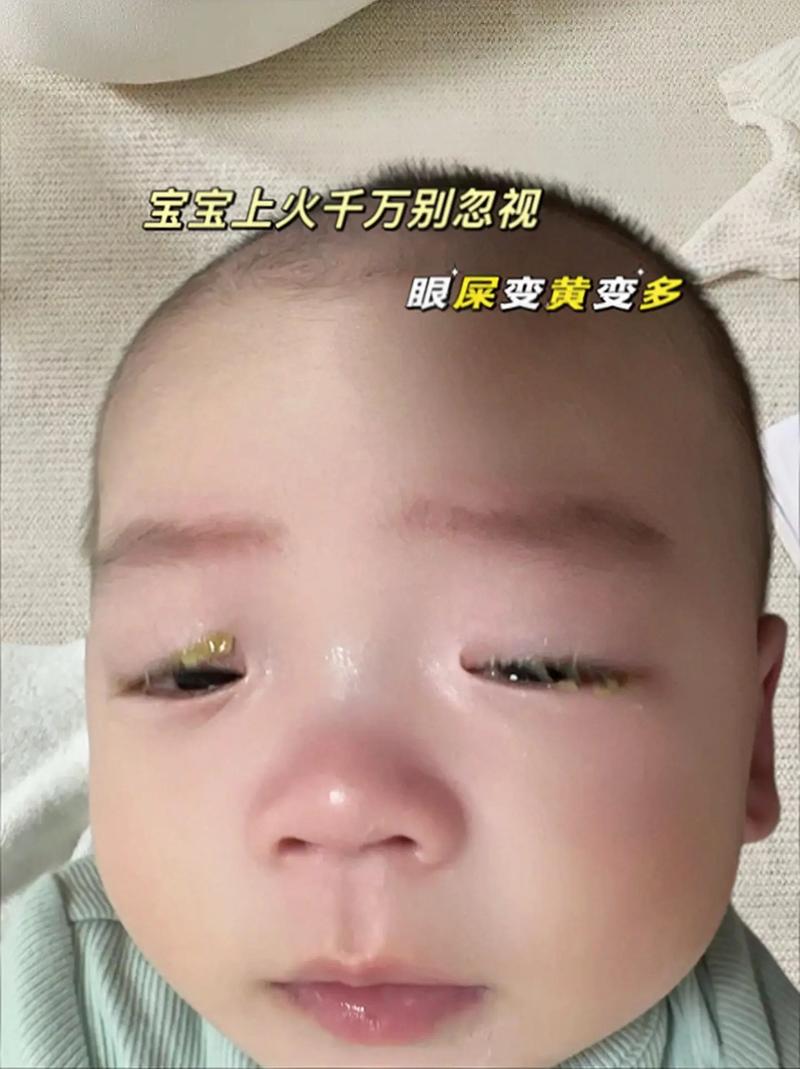 新生儿喝奶粉后眼屎多，是奶粉不合适还是上火？要换奶粉吗？-第1张图片-郑州医学网