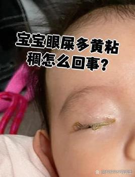 新生儿喝奶粉后眼屎多，是奶粉不合适还是上火？要换奶粉吗？-第2张图片-郑州医学网