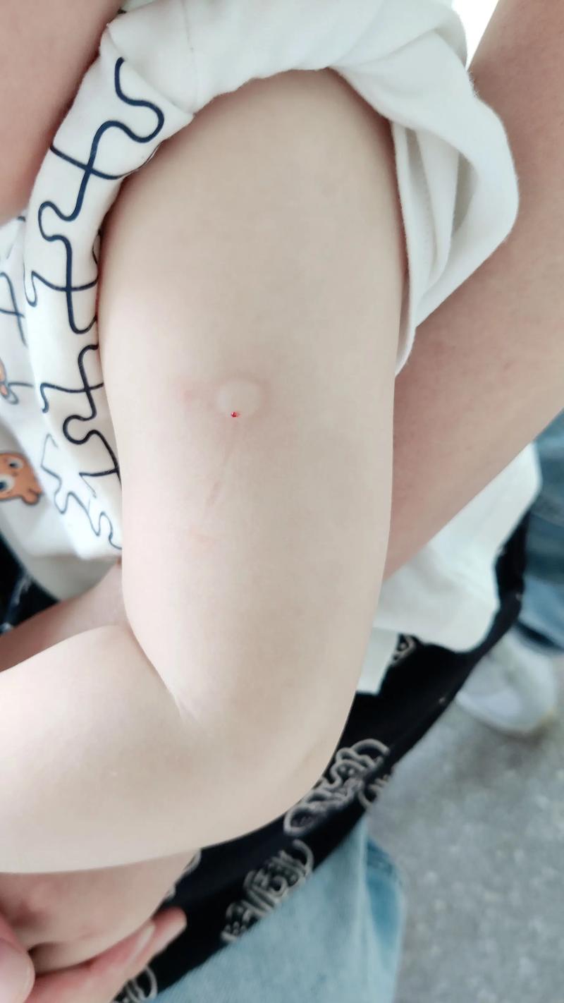 新生儿出院为何没打卡介苗？后续补种要注意什么？-第1张图片-郑州医学网