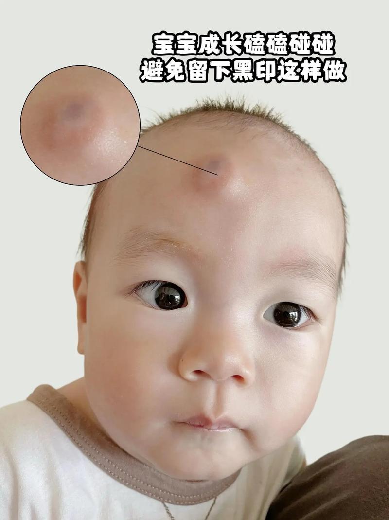 新生儿鼻子中间有条黑线是正常现象吗？需要担心或处理吗？-第3张图片-郑州医学网