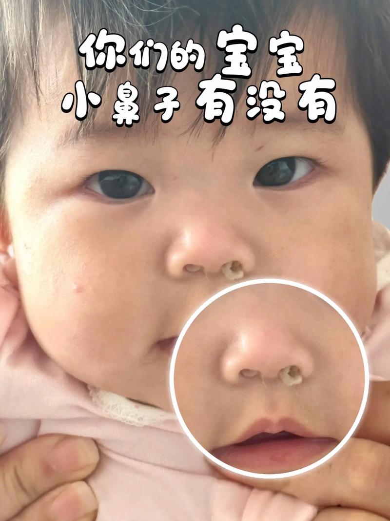 新生儿鼻子中间有条黑线是正常现象吗？需要担心或处理吗？-第2张图片-郑州医学网