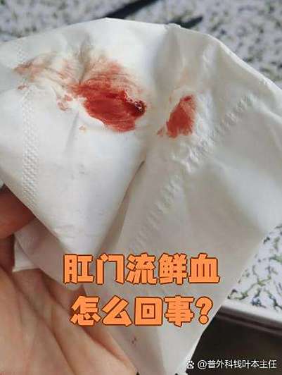 怀孕期间肛门出血是痔疮还是其他严重疾病信号?-第1张图片-郑州医学网 怀孕期间肛门出血是痔疮还是其他严重疾病信号?-第1张图片-郑州医学网