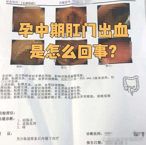 怀孕期间肛门出血是痔疮还是其他严重疾病信号?-第3张图片-郑州医学网 怀孕期间肛门出血是痔疮还是其他严重疾病信号?-第3张图片-郑州医学网