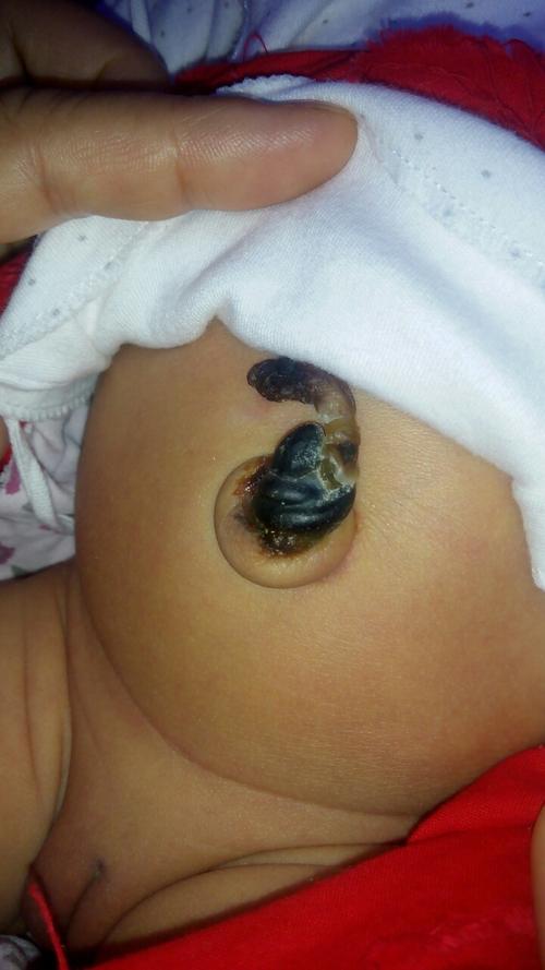 新生儿肚脐清洗后有点血是正常现象吗?需要特别处理吗?-第3张图片-郑州医学网 新生儿肚脐清洗后有点血是正常现象吗?需要特别处理吗?-第3张图片-郑州医学网