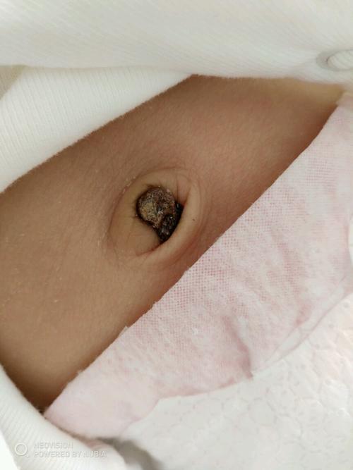 新生儿脐带感染会有哪些异常表现？家长该如何早期识别与处理？-第1张图片-郑州医学网