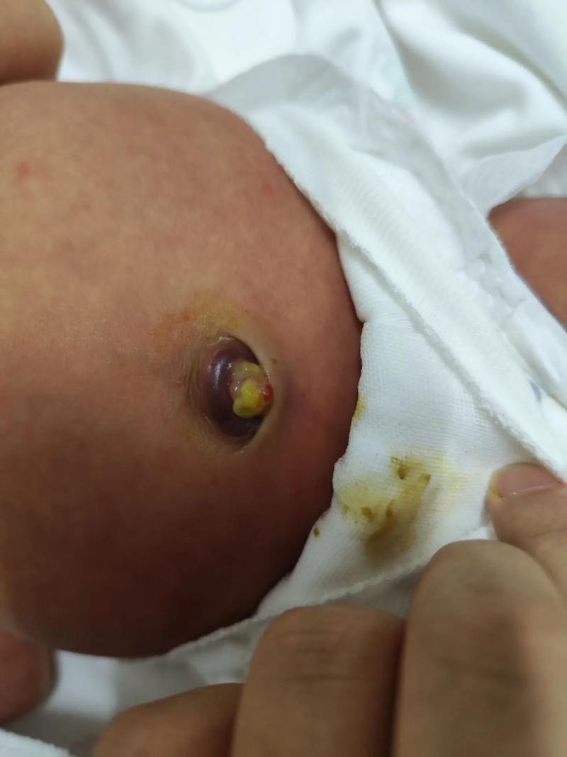 新生儿脐带感染会有哪些异常表现？家长该如何早期识别与处理？-第3张图片-郑州医学网