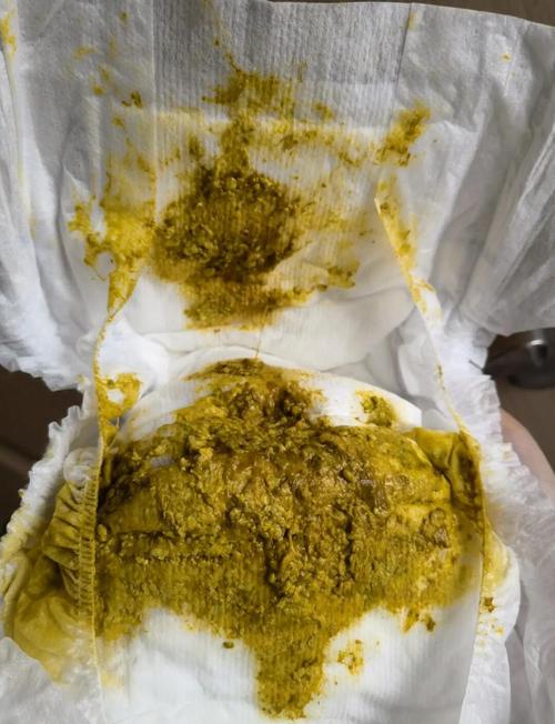 新生儿母乳喂养出现蛋花状大便，是消化异常还是正常现象？-第1张图片-郑州医学网