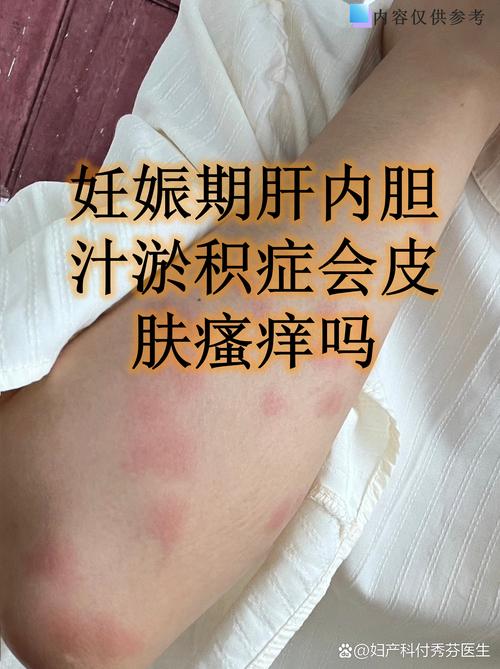 孕期胆汁淤积症有哪些典型症状？对母婴健康有何影响？-第1张图片-郑州医学网