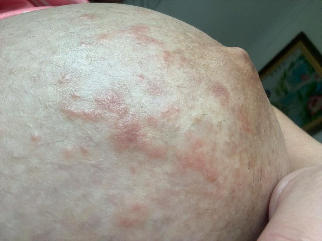 孕期胆汁淤积症有哪些典型症状？对母婴健康有何影响？-第2张图片-郑州医学网