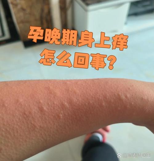 孕期胆汁淤积症有哪些典型症状？对母婴健康有何影响？-第3张图片-郑州医学网