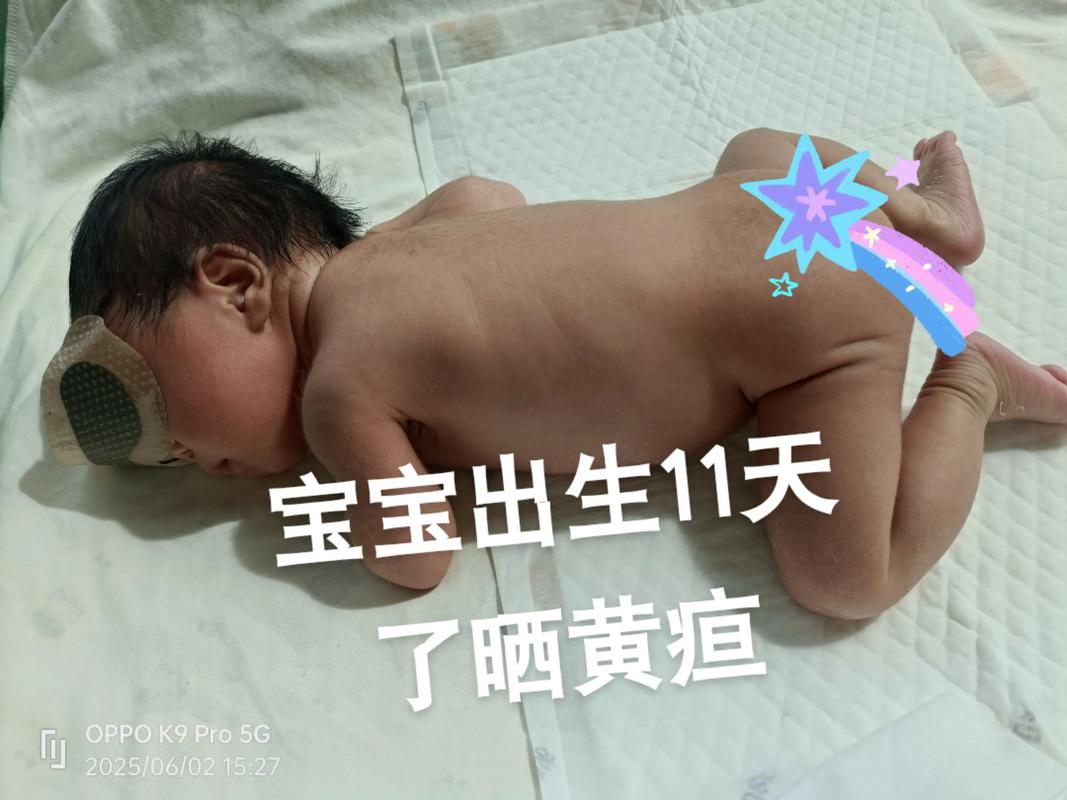 新生儿13天黄疸15mg/dl需要干预吗？正常范围是多少？-第2张图片-郑州医学网