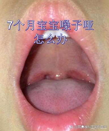 新生儿嗓子听着有吼吼声是正常现象吗？需要担心喉软骨发育问题吗？-第2张图片-郑州医学网