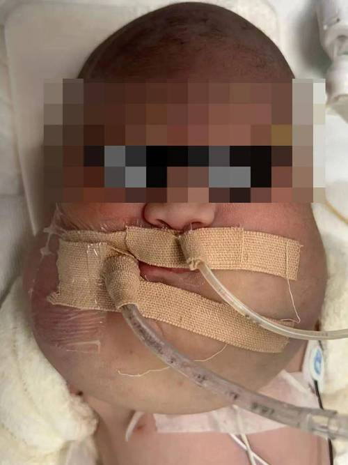 新生儿重度窒息后脑水肿，如何有效干预以减少神经后遗症风险？-第1张图片-郑州医学网