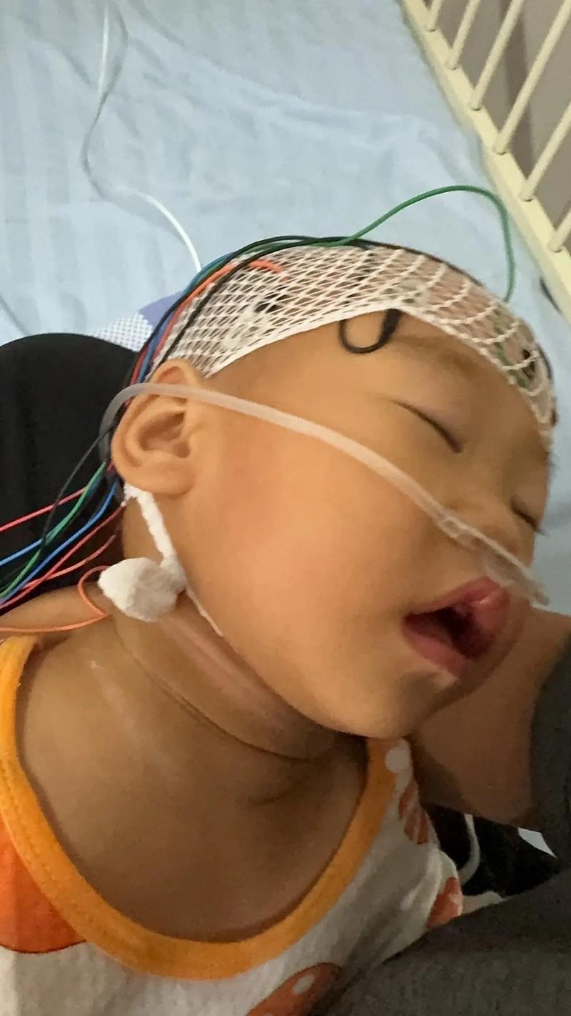 新生儿重度窒息后脑水肿，如何有效干预以减少神经后遗症风险？-第2张图片-郑州医学网