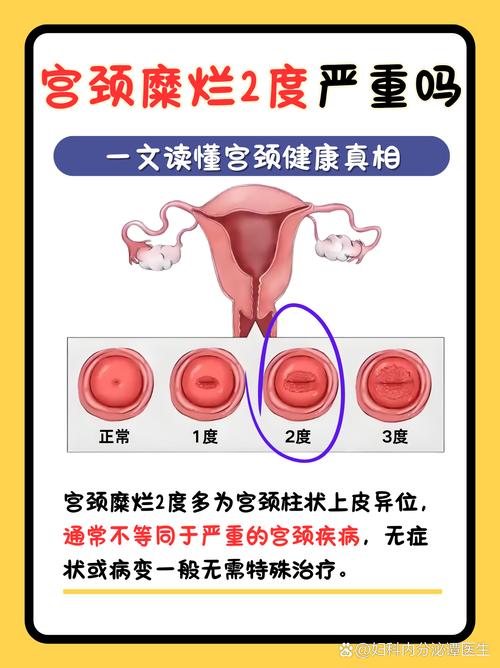 孕期宫颈糜烂影响胎儿吗？安全治疗方法有哪些？-第1张图片-郑州医学网