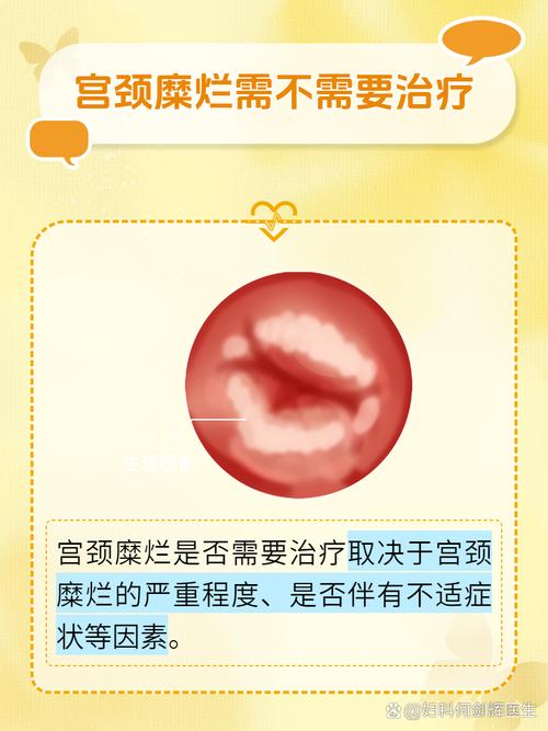 孕期宫颈糜烂影响胎儿吗？安全治疗方法有哪些？-第3张图片-郑州医学网