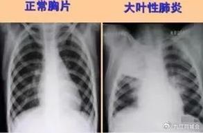 新生儿肺部拍片真的安全吗？辐射风险到底有多大？-第1张图片-郑州医学网