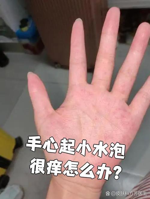 儿童手心湿疹反复发作，该如何有效治疗并预防复发？-第1张图片-郑州医学网