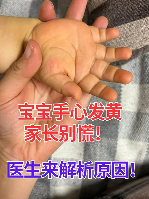 儿童手心湿疹反复发作，该如何有效治疗并预防复发？-第2张图片-郑州医学网