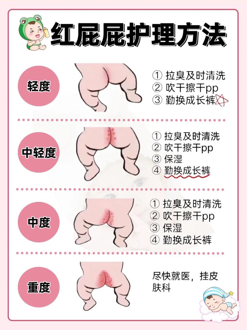 新生儿尿不湿总漏尿？是尺码选错还是穿戴方式有问题？-第2张图片-郑州医学网