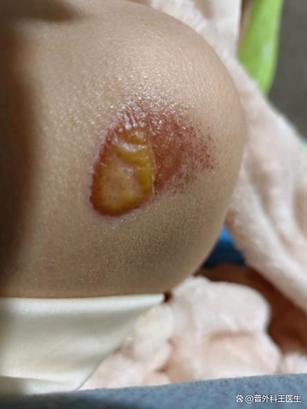 新生儿菊花周围破皮了怎么办？需要涂药还是就医处理？-第1张图片-郑州医学网