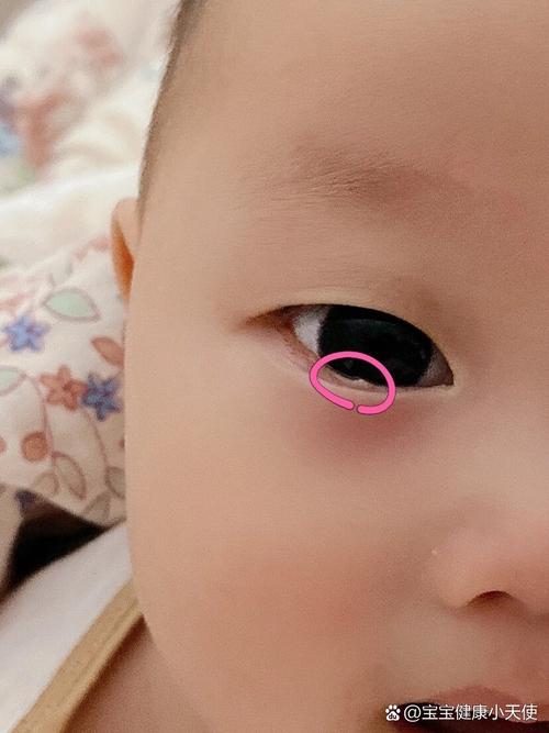 新生儿眼睛上的膜状物是什么？需要治疗吗？会影响视力发育吗？-第2张图片-郑州医学网