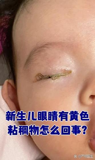 新生儿眼睛上的膜状物是什么？需要治疗吗？会影响视力发育吗？-第1张图片-郑州医学网