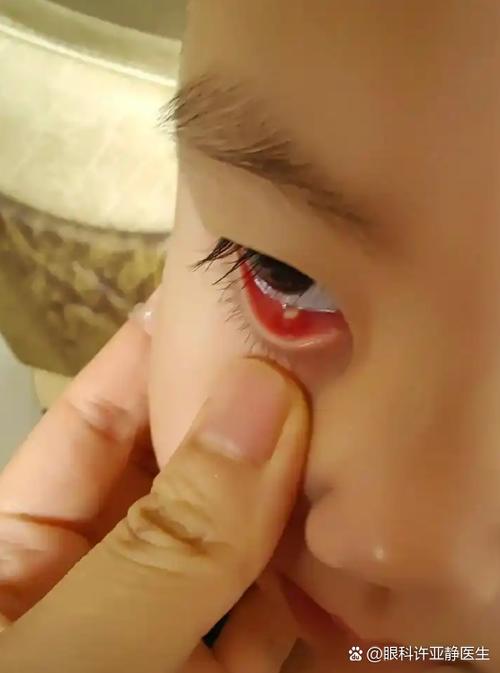 新生儿眼睛上的膜状物是什么？需要治疗吗？会影响视力发育吗？-第3张图片-郑州医学网