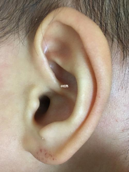 新生儿耳朵上的小点点是什么？需要担心吗？会对听力有影响吗？-第1张图片-郑州医学网